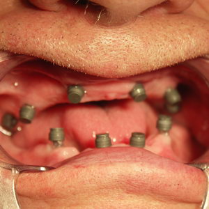Стабилизация съемных зубных протезов с помощью мини-имплантатов MPI
