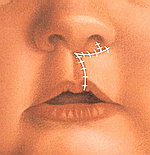 Врожденные пороки верхней губы - хейлопластика
