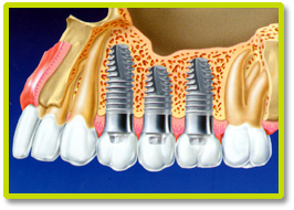 Дентальная имплантология