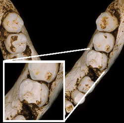Были ли у стоматологов 12 тысяч лет назад методы лечения зубных каналов?
