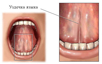 Пластика уздечки языка 