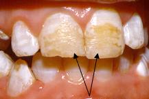Гипоплазия эмали 
