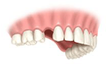Восстановление одного потерянного зуба