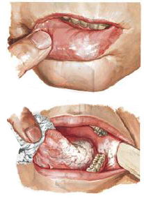 лейкоплакия полости рта классификация