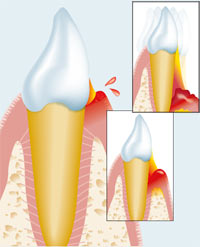 Лечение пародонтита и пародонтоза