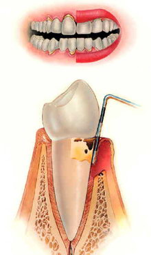 Периодонтит